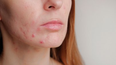 sebium_maskne_acne-women