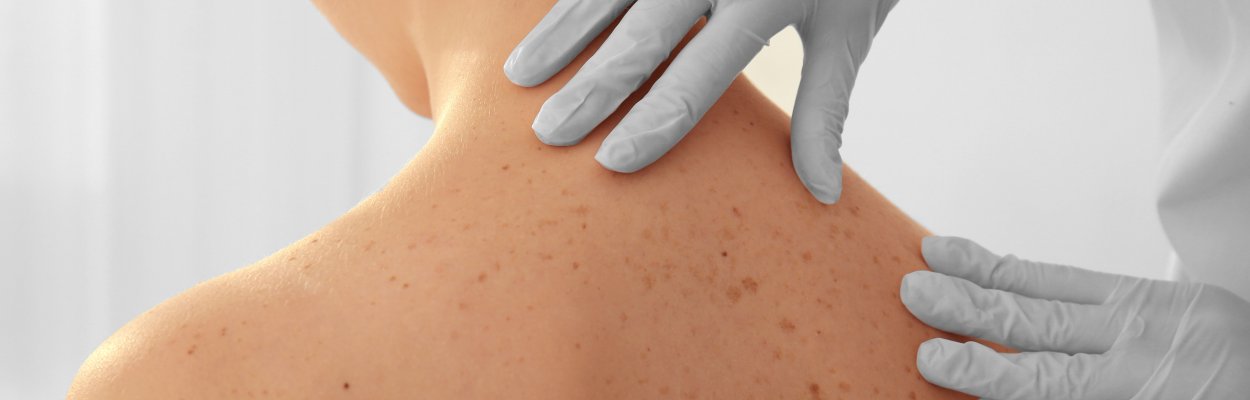 Imagen de persona con lunares