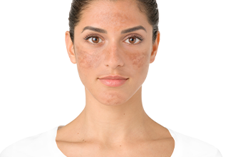 Imagen de persona con pecas