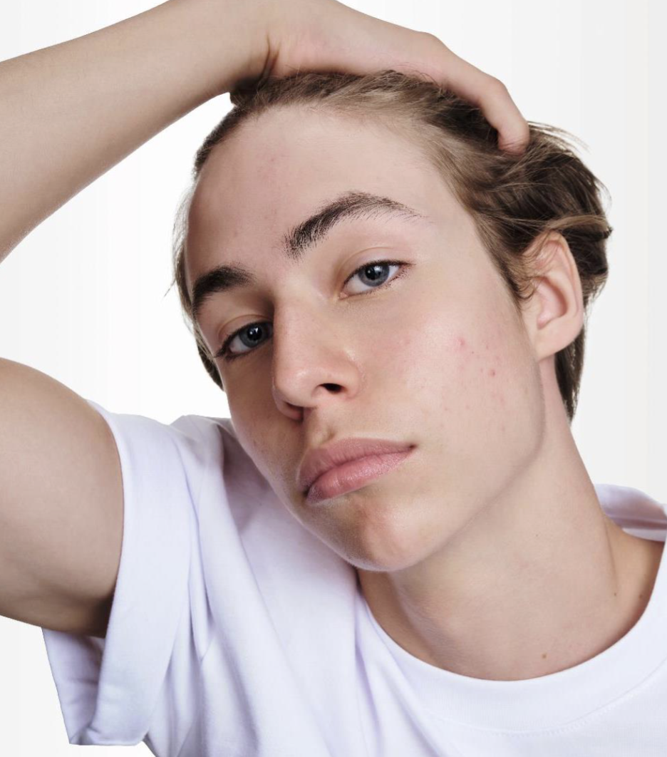 Adolescente con acné leve mostrando piel real