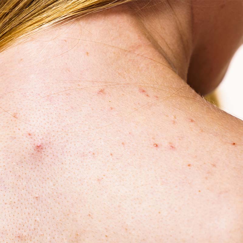 Mujer con acné en la espalda