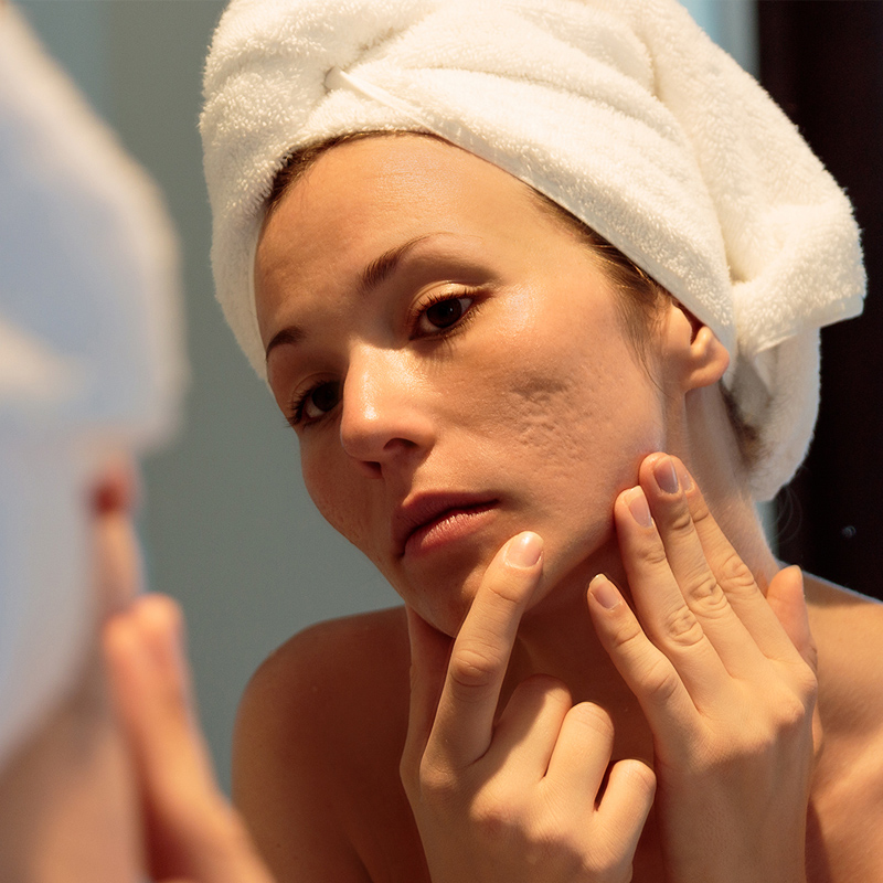 Mujer con cicatrices y marcas de acné