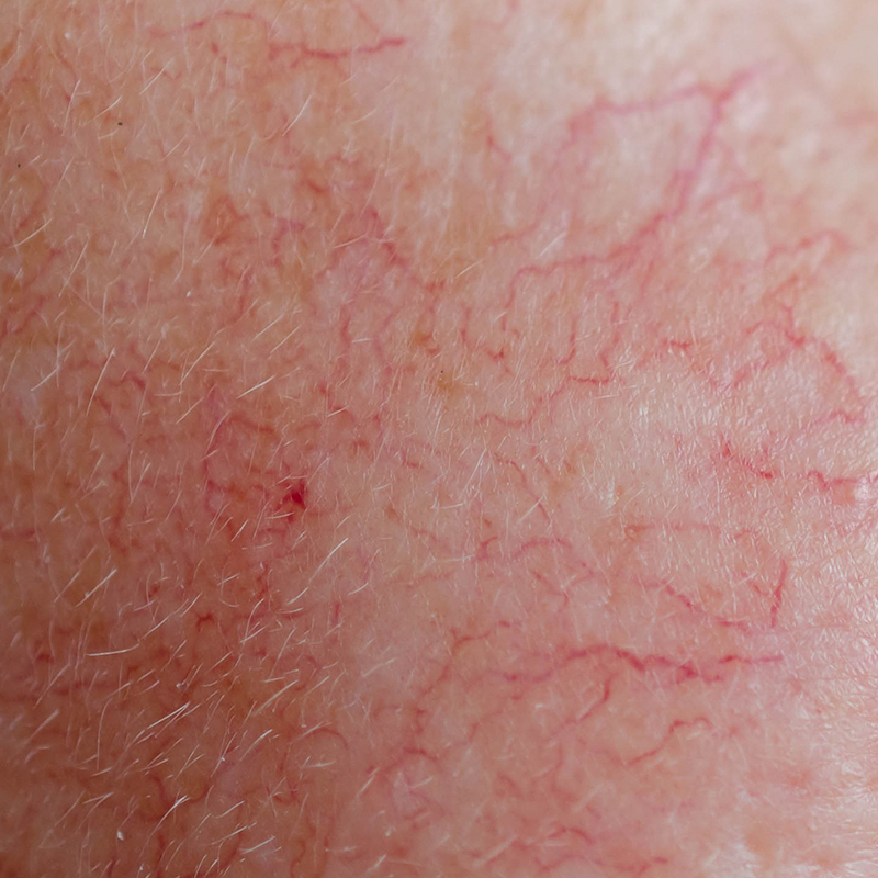 Primer plano de la piel del rostro que muestra un enrojecimiento persistente