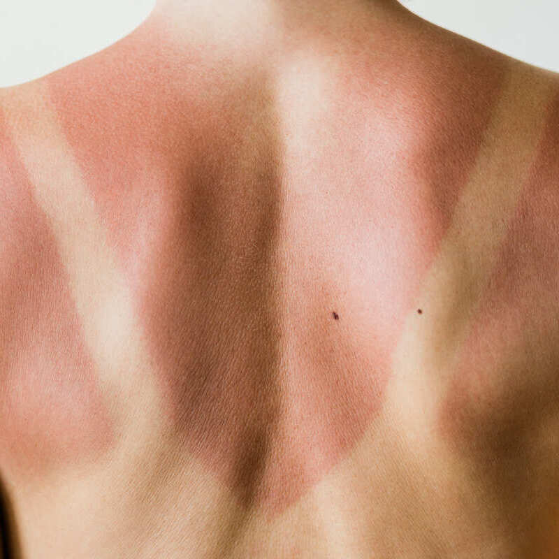 Piel y bronceado solar en la espalda