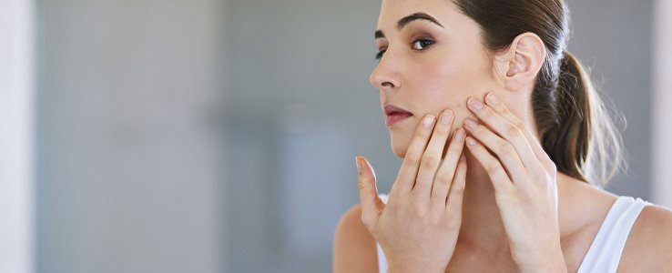 Imagen de chica con acné