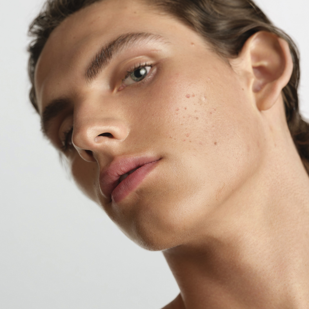 Rostro masculino con acné activo y marcas visibles, 