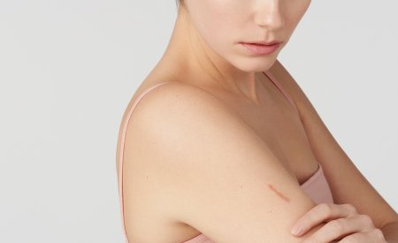 piel con cicatrices piel dañada woman with scar